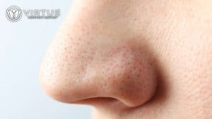Nasal Spray Addiction Treatment Options Rhinitis Medicamentosa